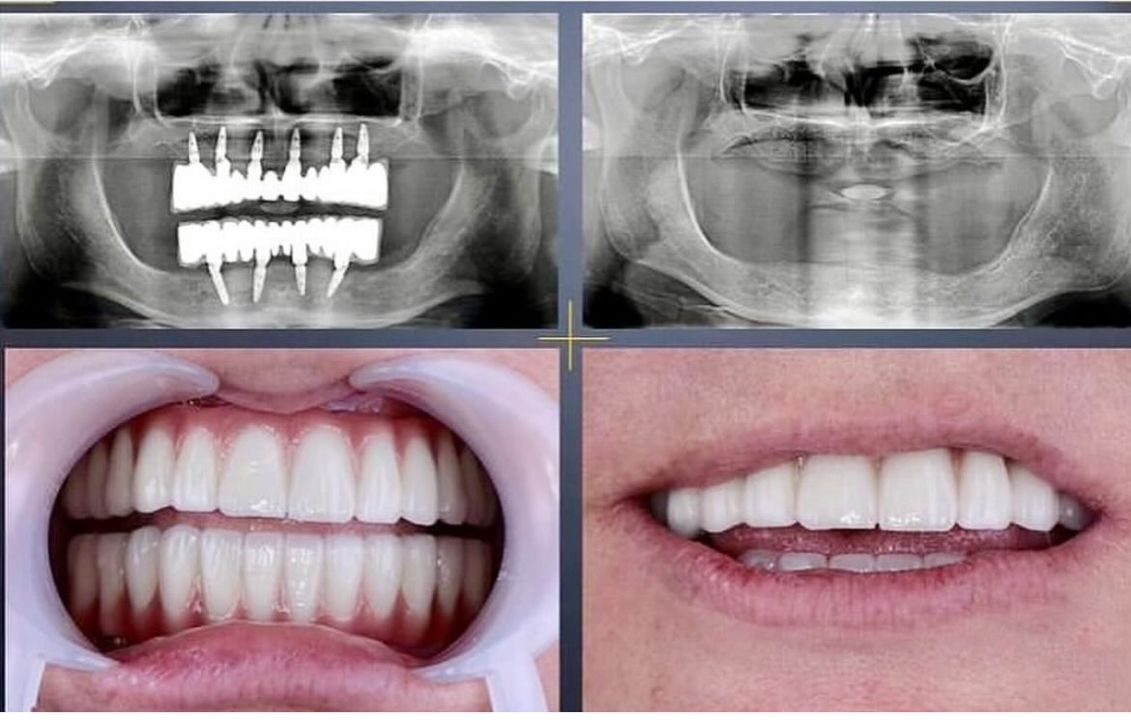 Tam ağız implant rehabilitasyonu sonrası gülüş ve panoramik planlama görselleri